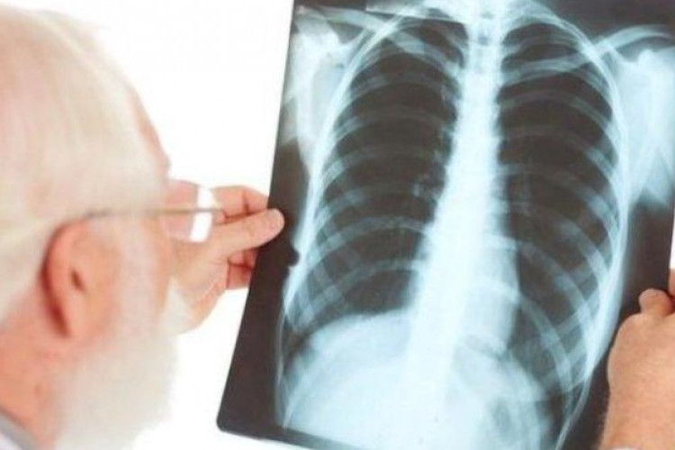 Kode ICD 10 TB Paru Apa Saja? Berikut Daftar Kode Pada Penyakit Tuberkulosis yang Harus Kamu Tau!