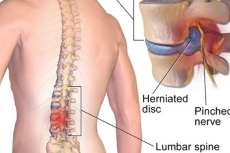 ICD 10 HNP Adalah? Pengertian serta Peran dalam Mendiagnosa